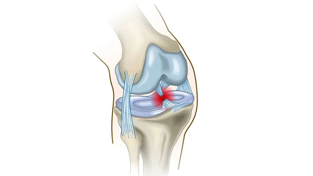 膝关节损伤图片