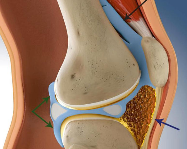 What is Arthrofibrosis | International Arthrofibrosis Association