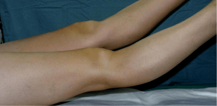 Is Full Hyperextension Needed After Knee Surgery? – NASMI