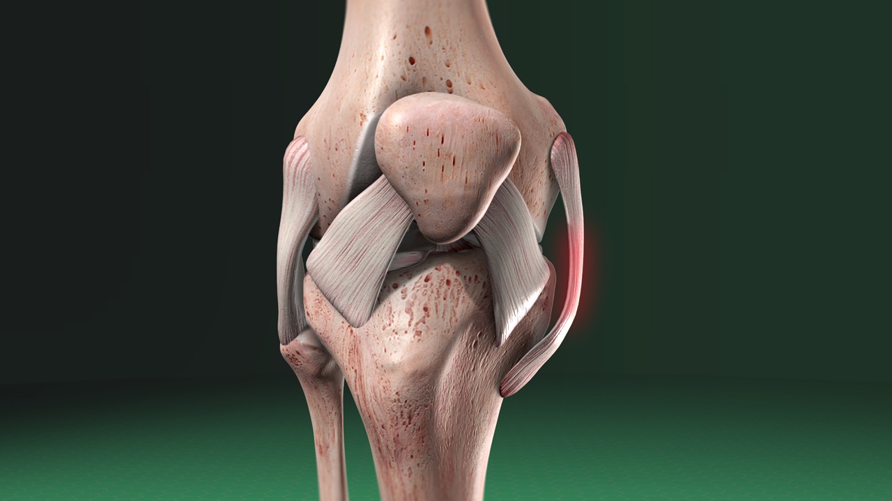 Medial Collateral Ligament (MCL) Injury